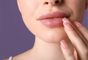 Woman's lips after filler.