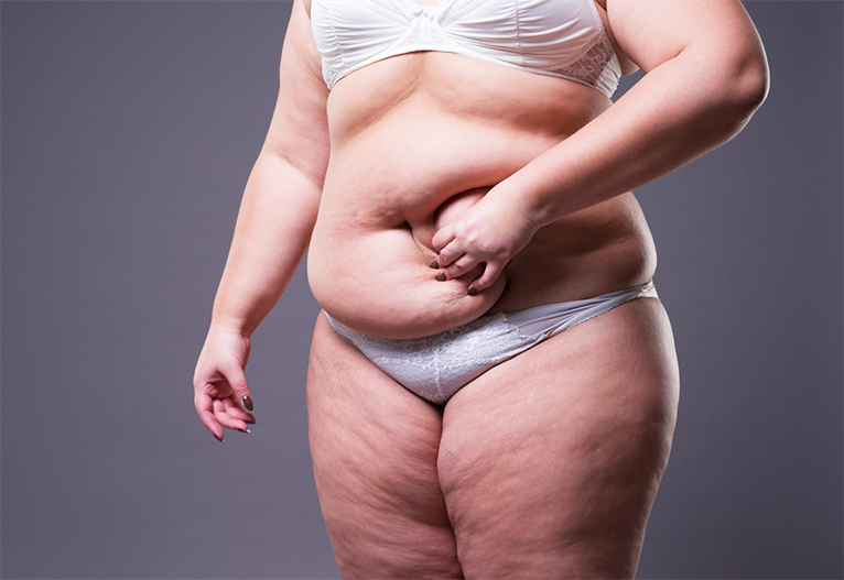 Woman in underwear with sagging skin.