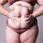 Woman holding sagging stomach.