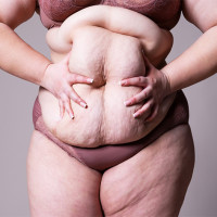 Woman holding sagging stomach.