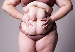 Woman holding sagging stomach.