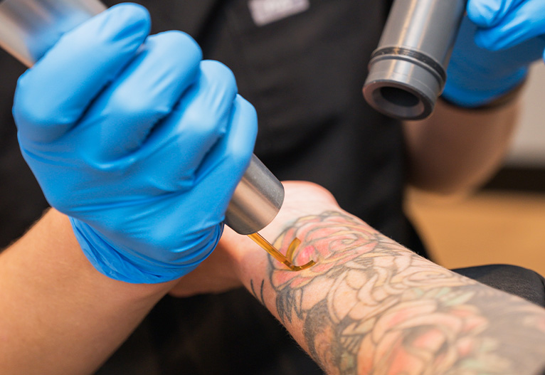 Tattoo removal process.