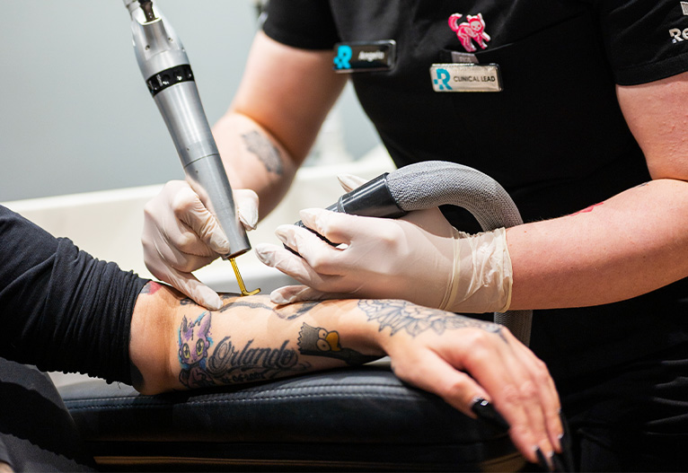 Person having a tattoo removed with laser technology.