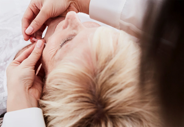 Woman getting facial acupuncture.