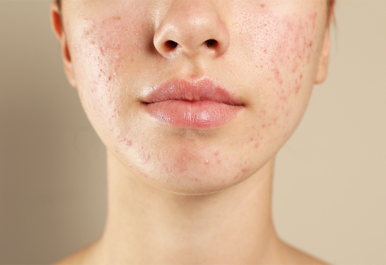 Woman with acne on her face.