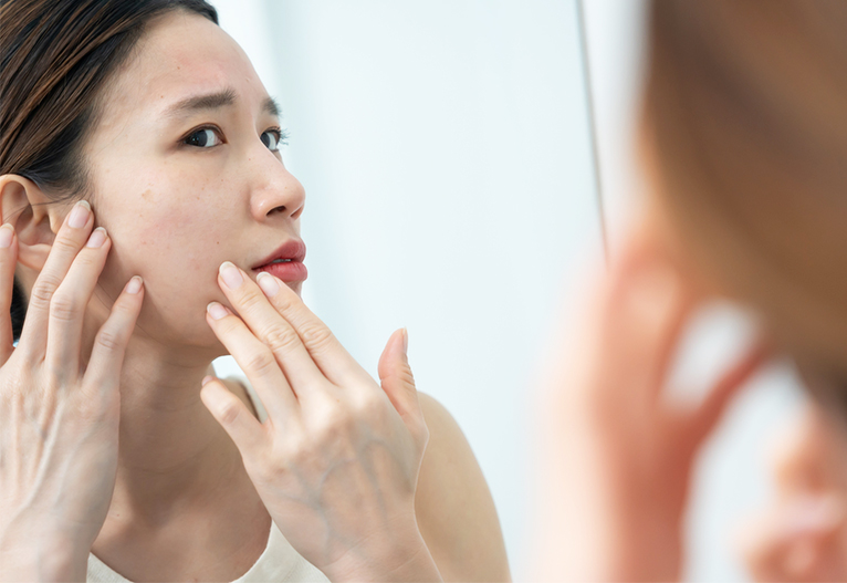 Acne Management: Doctor Reveals 5 Key Steps