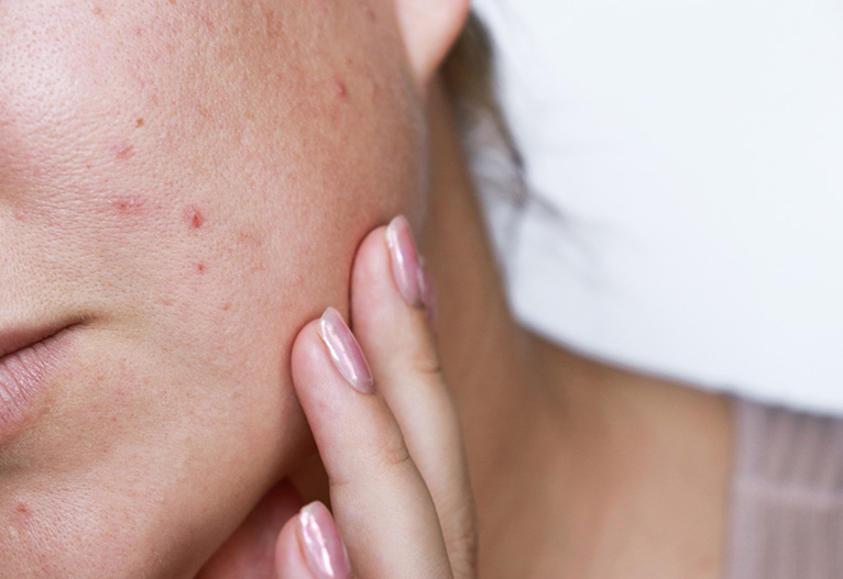 Woman with acne touching her face.