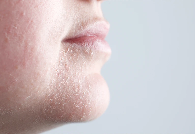 Dry skin around a mature woman's mouth and chin.