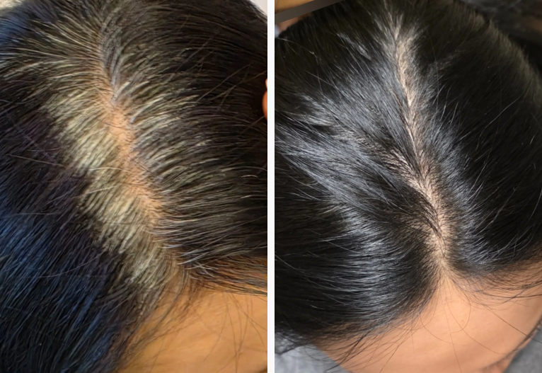 Woman's hairline before and after Clairol Nice N Easy hair colour.